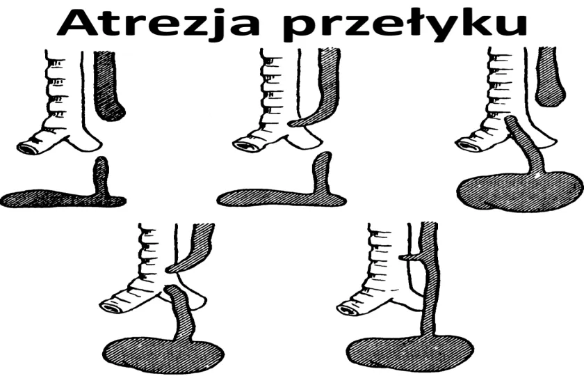 Atrezja przełyku 