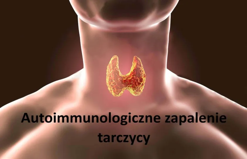 Autoimmunologiczne zapalenie tarczycy