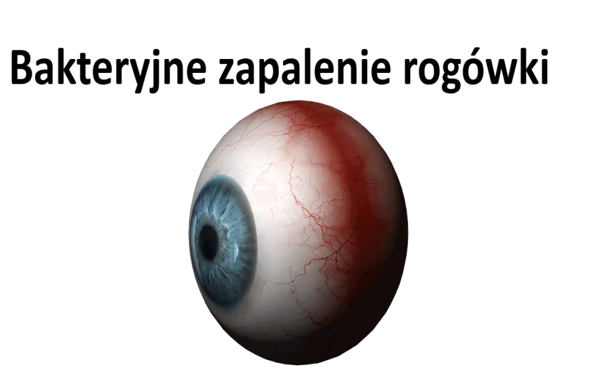 Bakteryjne zapalenie rogówki 