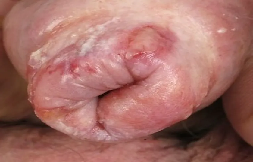 Balanitis xerotica obliterans 