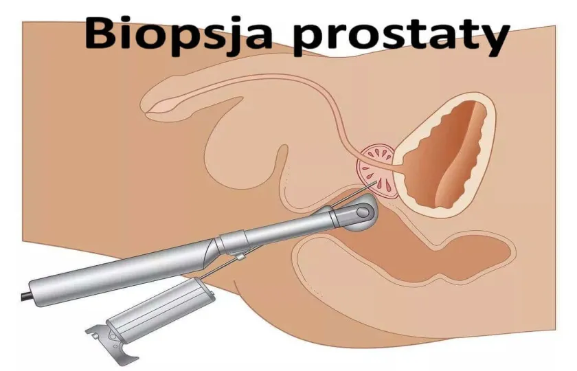 Biopsja prostaty, biopsja stercza