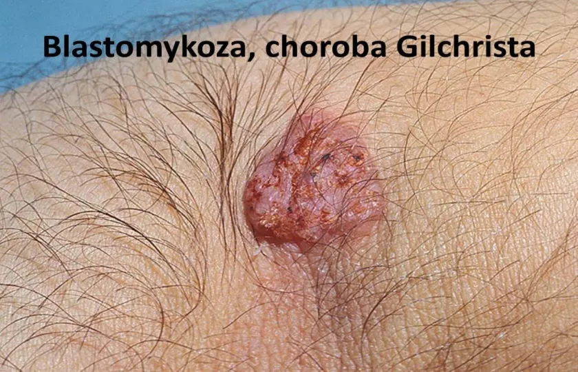 Blastomykoza, choroba Gilchrista