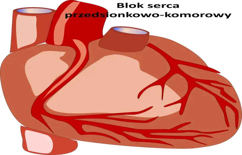 Blok serca przedsionkowo-komorowy