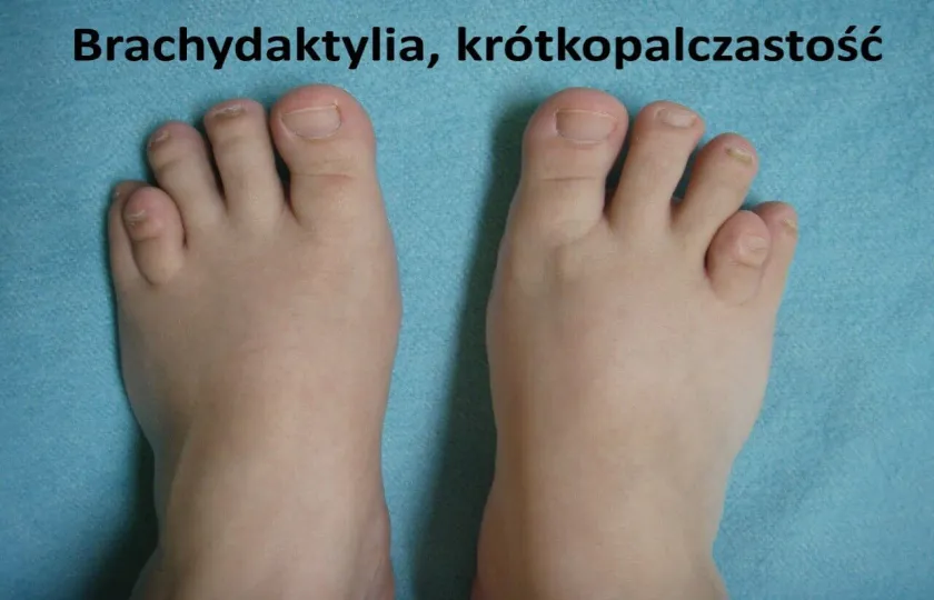 Brachydaktylia, krótkopalczastość, brachydactyly 