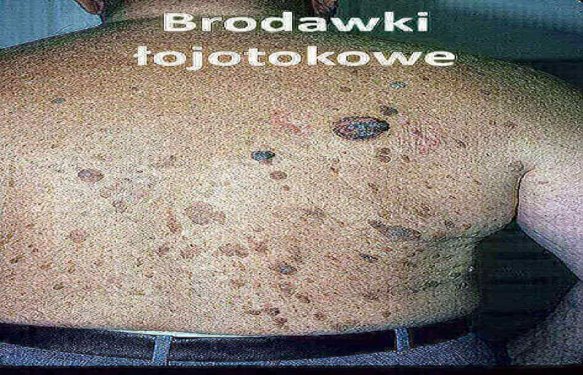 Brodawki łojotokowe 