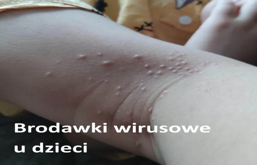 Brodawki wirusowe u dzieci 