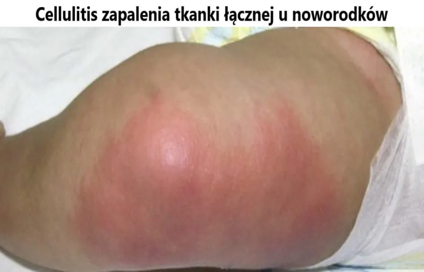 Cellulitis, zapalenia tkanki łącznej u noworodków
