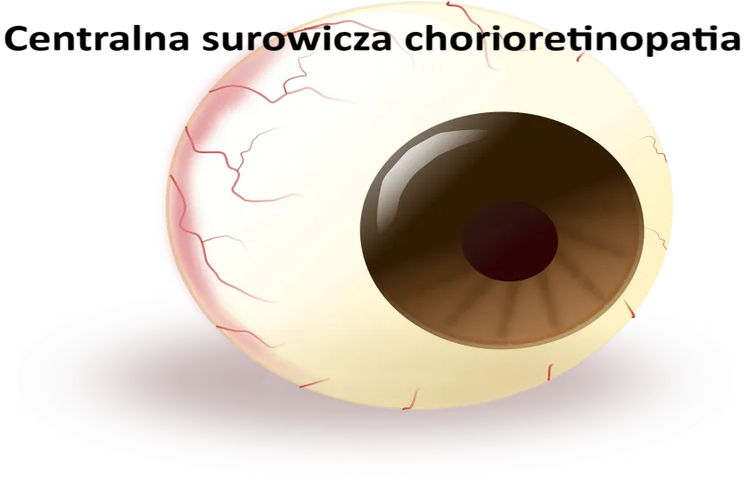 Centralna surowicza chorioretinopatia, central serous chorioretinopathy (CSCR) 