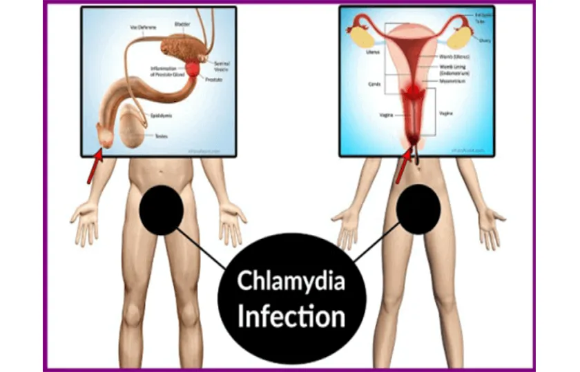 chlamydia
