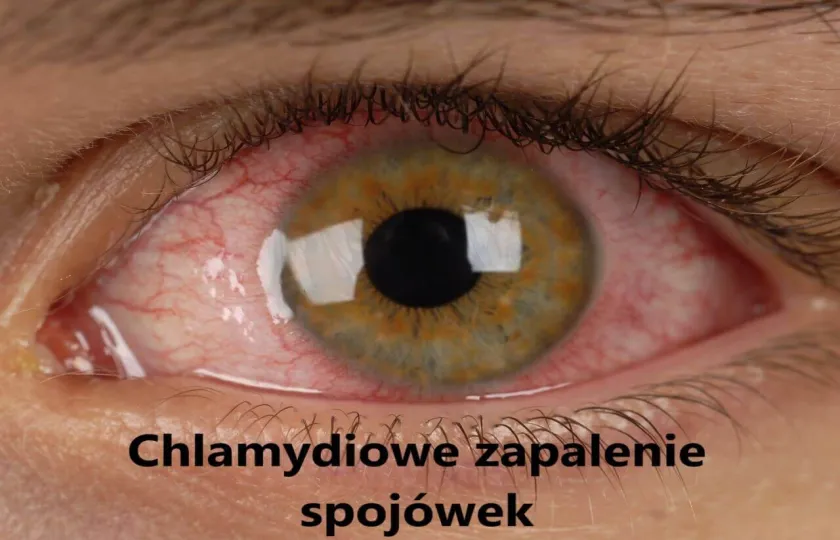 Chlamydiowe zapalenie spojówek, wtrętowe zapalenie spojówek
