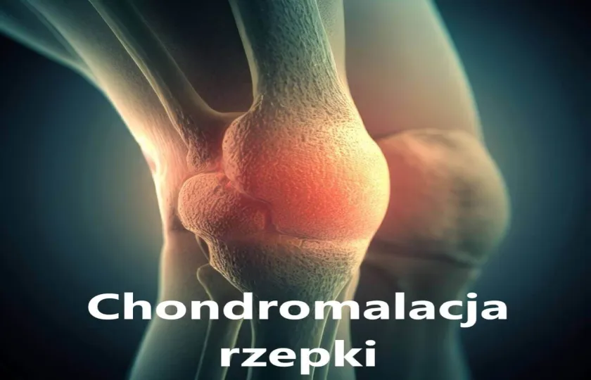 Chondromalacja rzepki, rozmiękanie rozpulchnienia, rozpulchnienia chrząstki stawowej 