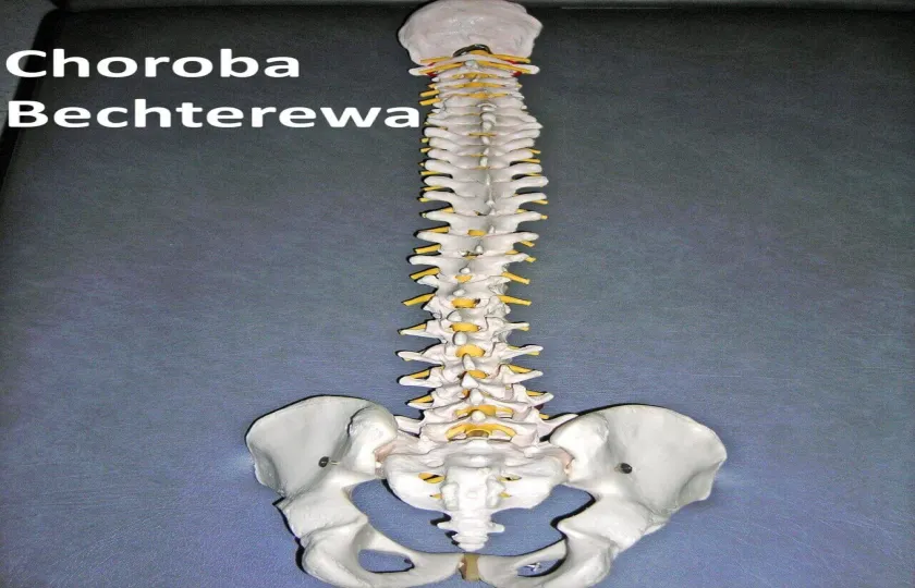 Choroba Bechterewa, zesztywniające zapalenie stawów kręgosłupa ZZSK 