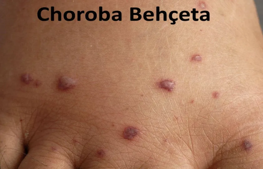 Choroba Behçeta 