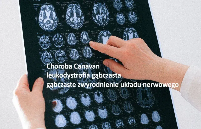 Choroba Canavan, leukodystrofia gąbczasta, gąbczaste zwyrodnienie układu nerwowego
