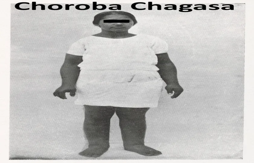 Choroba Chagasa, trypanosomoza amerykańska