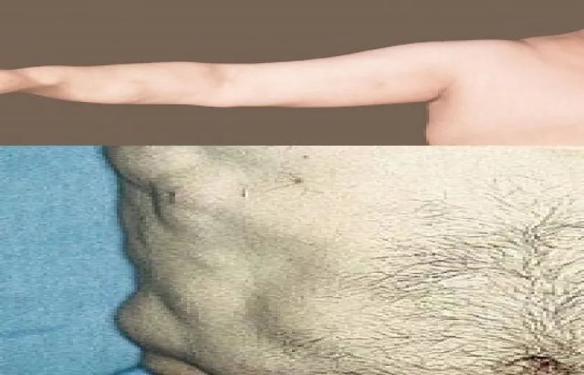 Choroba Dercuma (bolesna lipomatoza)