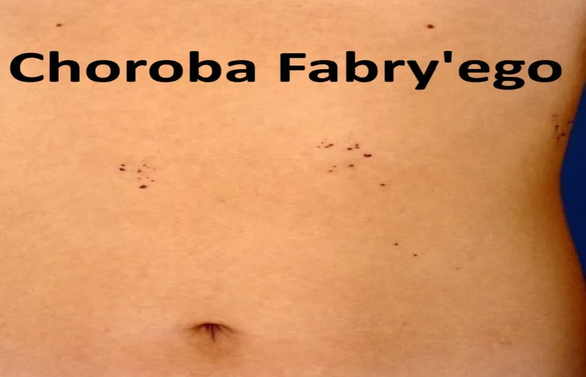 Choroba Fabry'ego