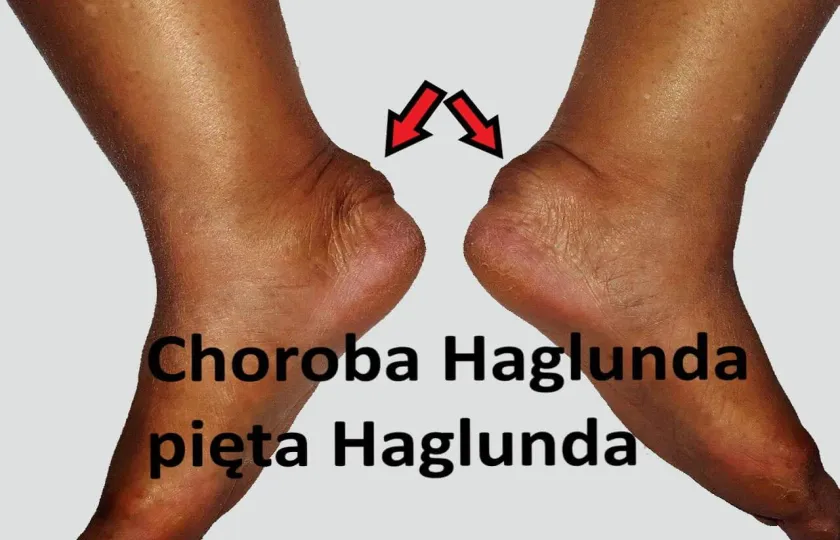 Choroba Haglunda, pięta Haglunda, jałowa martwica kości piętowej