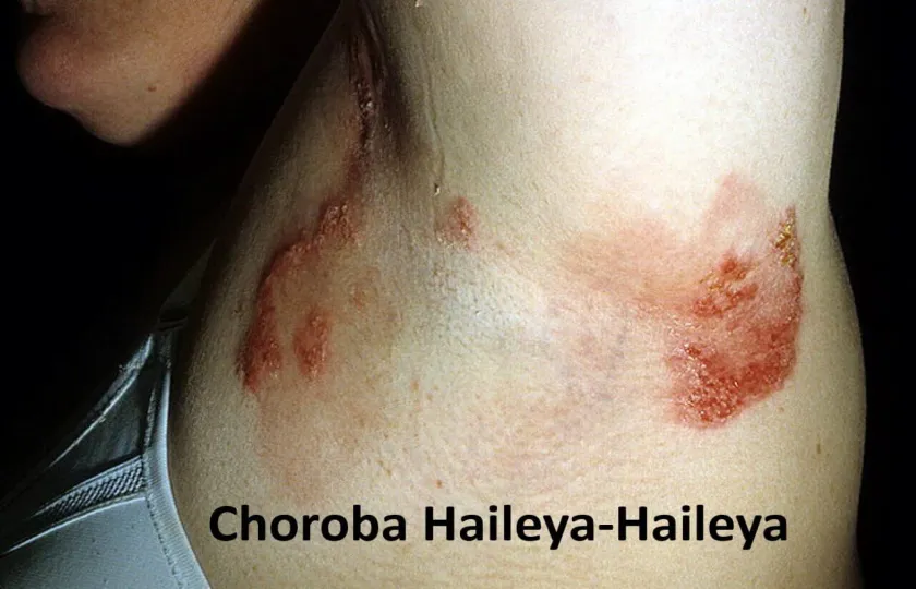 Choroba Haileya-Haileya