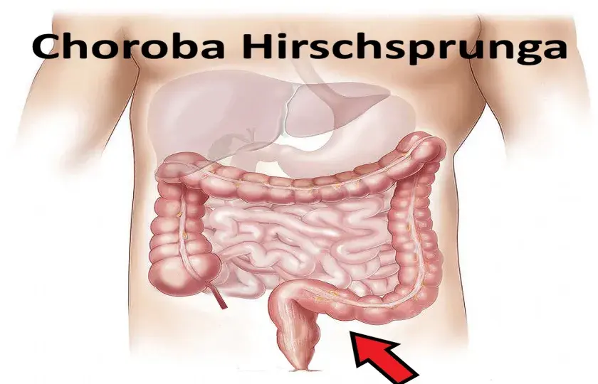 Choroba Hirschsprunga