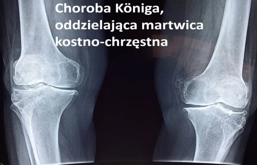 Choroba Königa, oddzielająca martwica kostno-chrzęstna 