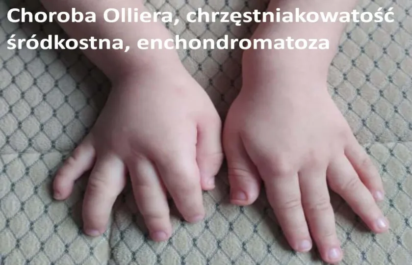 Choroba Olliera, chrzęstniakowatość śródkostna, enchondromatoza