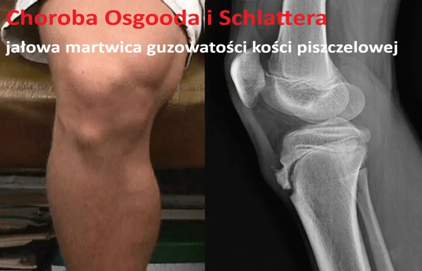 Choroba Osgooda i Schlattera, jałowa martwica guzowatości kości piszczelowej