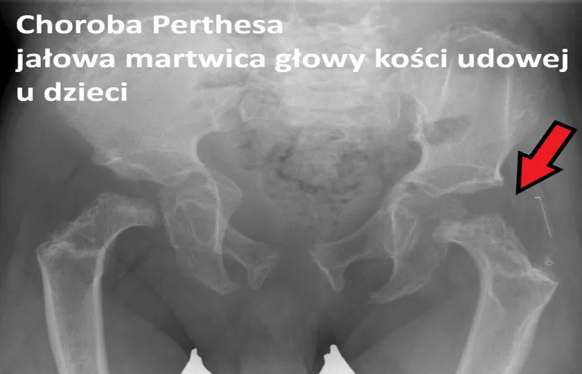 Choroba Perthesa, jałowa martwica głowy kości udowej u dzieci 