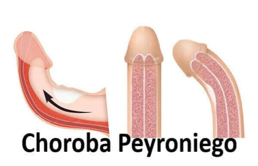 Choroba Peyroniego