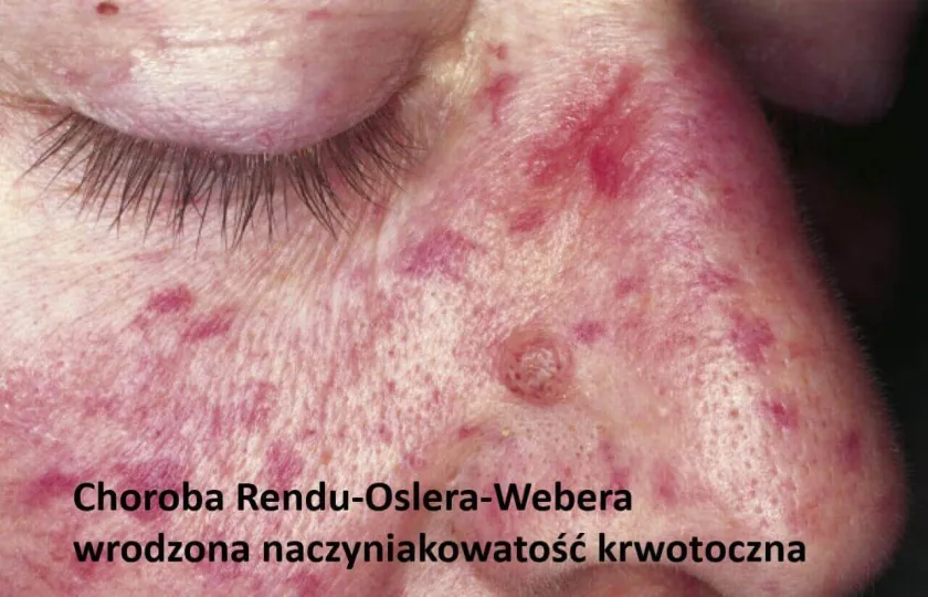 Choroba Rendu-Oslera-Webera, wrodzona naczyniakowatość krwotoczna