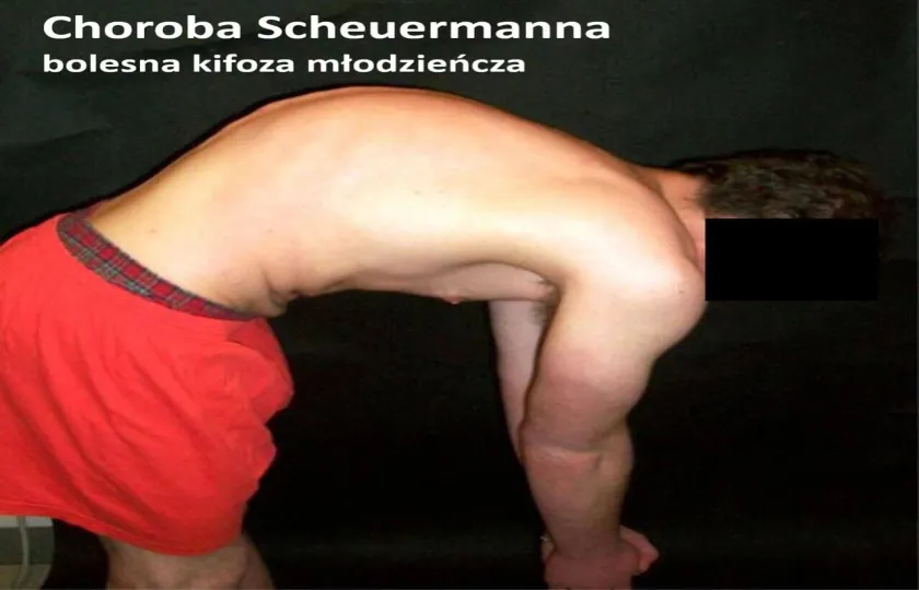 Choroba Scheuermanna, bolesna kifoza młodzieńcza 