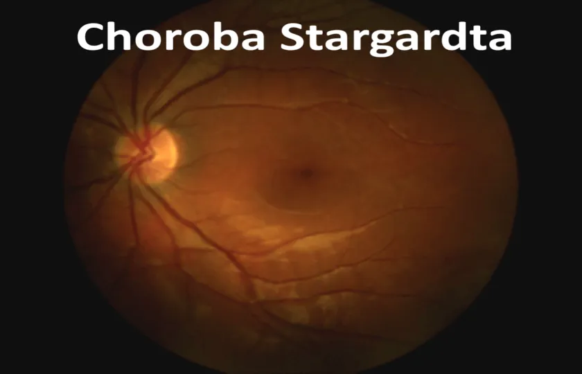 Choroba Stargardta