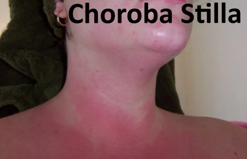 Choroba Stilla