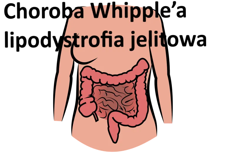 Choroba Whipple’a, lipodystrofia jelitowa 