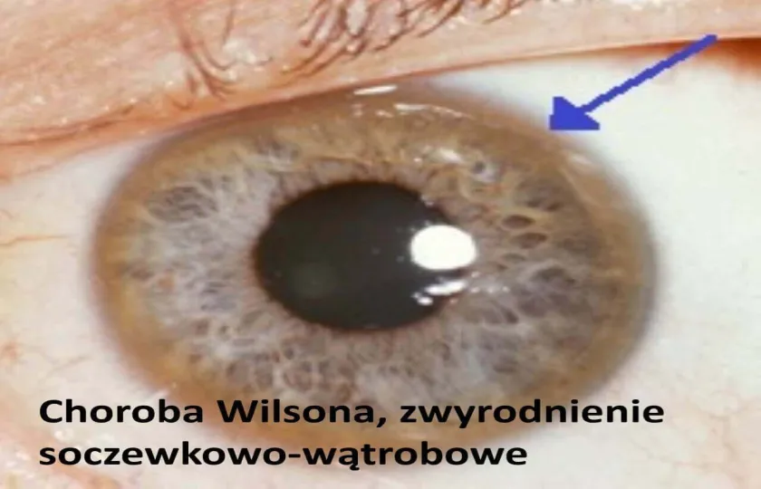 Choroba Wilsona, zwyrodnienie soczewkowo-wątrobowe 