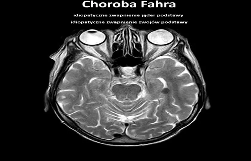 Choroba Fahara
