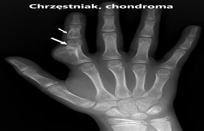 Chrzęstniak, chondroma
