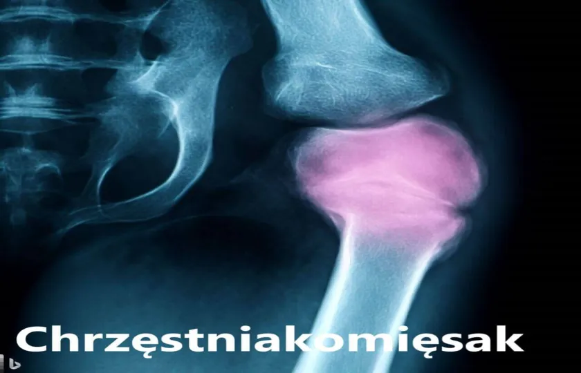 Chrzęstniakomięsak