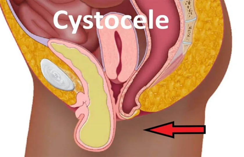 CYSTOCELE, co to, obniżenie przedniej ściany pochwy to cystocele objawy operacja zdjęcia