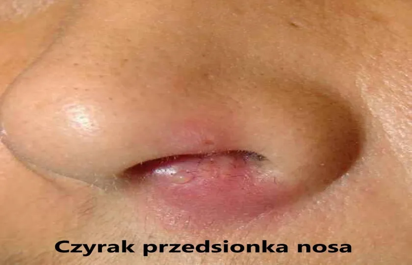Czyrak przedsionka nosa, czyrak w nosie