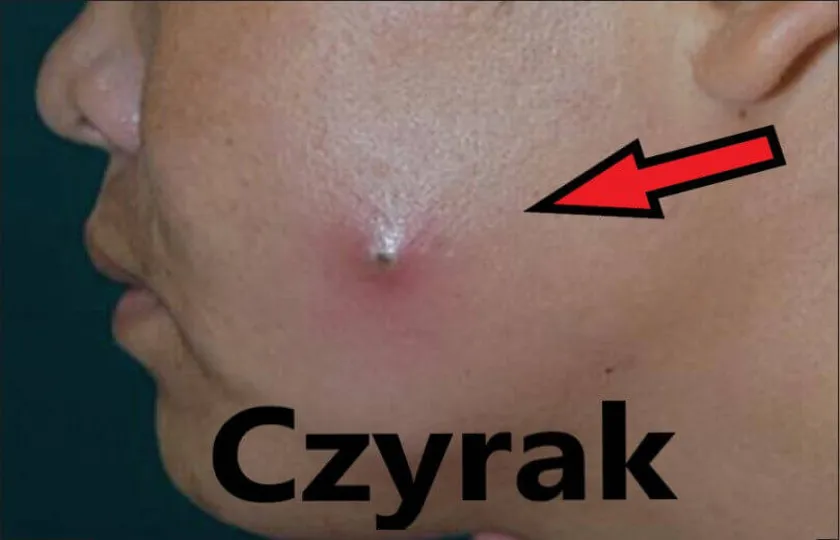 Czyrak 