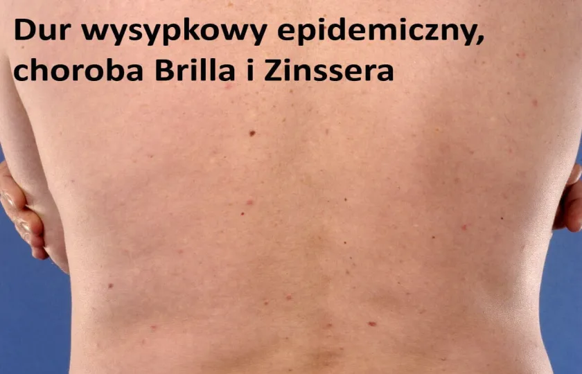 Dur wysypkowy epidemiczny, choroba Brilla i Zinssera 