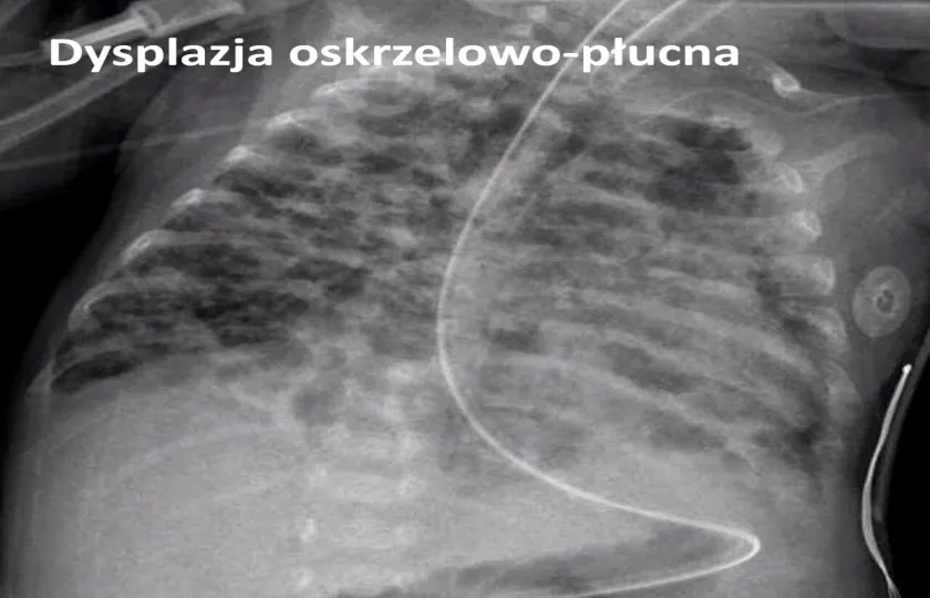Dysplazja oskrzelowo-płucna