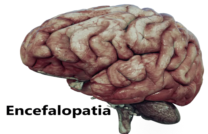 Encefalopatia 