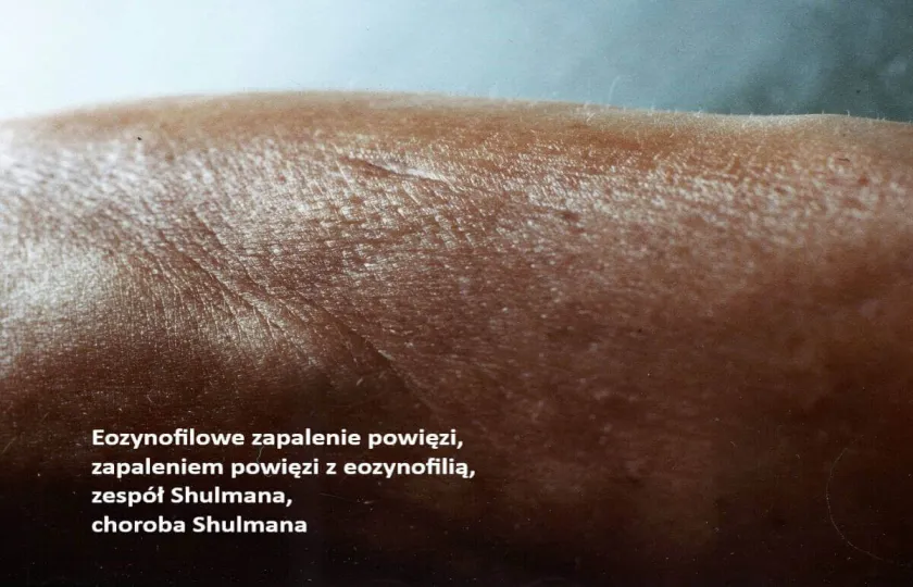 Eozynofilowe zapalenie powięzi, zapaleniem powięzi z eozynofilią, zespół Shulmana, choroba Shulmana
