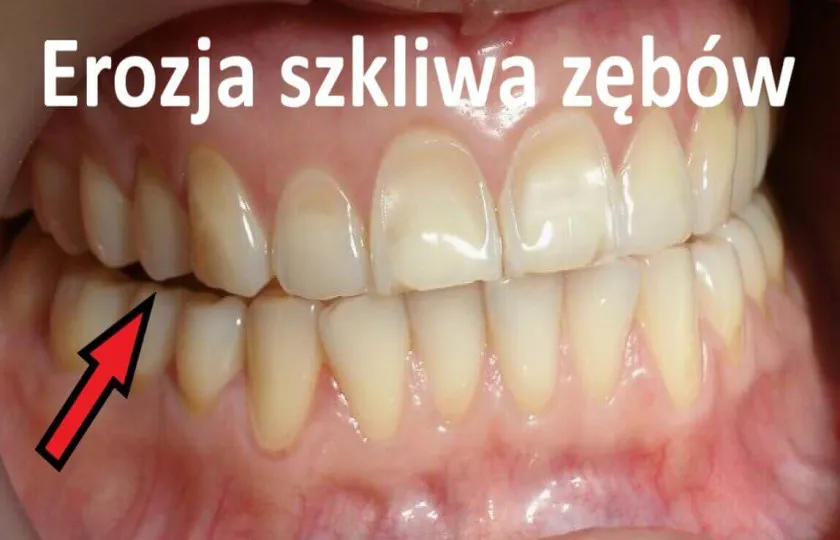 erozja szkliwa zębów, nadżerka zębów 