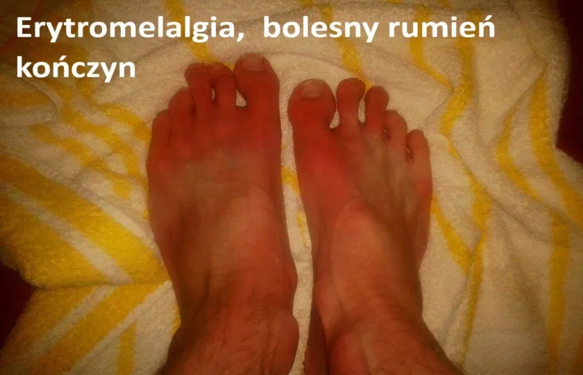 Erytromelalgia, bolesny rumień kończyn 