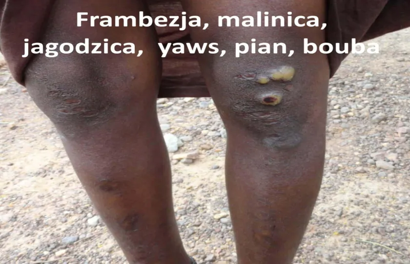 Frambezja, malinica, jagodzica, yaws, pian, bouba 