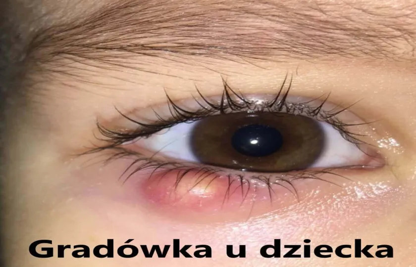 Gradówka u dziecka