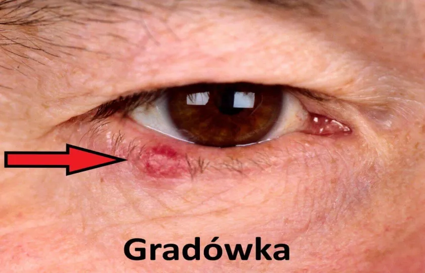 Gradówka 